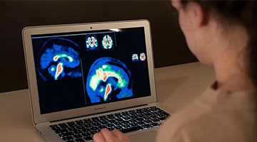 Investigadores europeos mejoran la sensibilidad del diagnóstico de las fases iniciales del Alzheimer