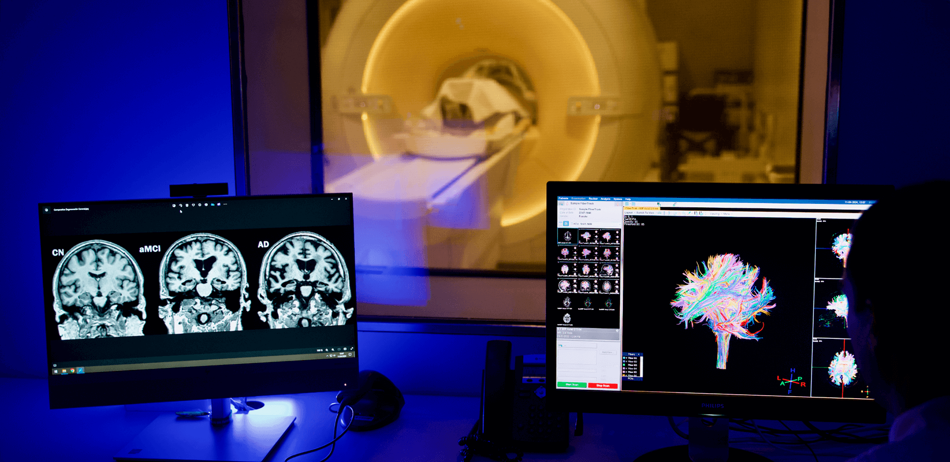 Junts, unint esforços per vèncer l’Alzheimer